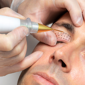 Fibroblast (face lift)